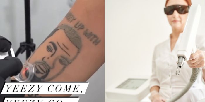 tattoo of kanye west in the process of being removed, alongside a photo of a woman operating a laser tattoo removal machine